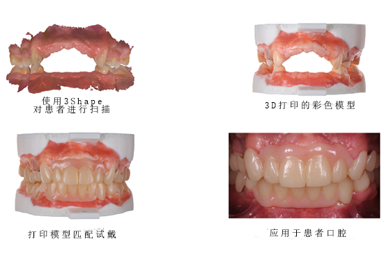 3Shape彩色工作流程，讓牙齒假體越來越“真”！